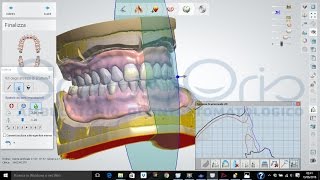 Digital workflow for removable full dentures