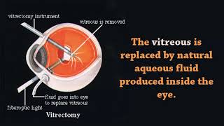 Vitreomacular Traction Surgery By Mahi Muqit