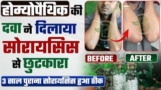 मेरी सोरायसिस की यात्रा | Psoriasis journey vlog | होम्योपैथिक की दवा ने दिलाया सोरायसिस से छुटकारा