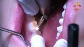 DIRECTA ● FenderPrime - Lower Second Molar