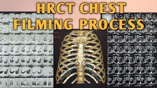 HRCT CHEST FILMING PROCESS II CT CHEST FILMING II NCCT CHEST FILMING#