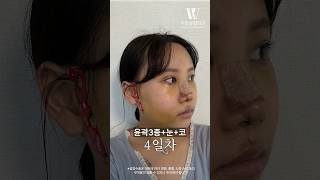 안면윤곽+눈+코 후기 #short #plasticsurgeryinkorea