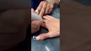 Como tirar uma tattoo com jato de plasma