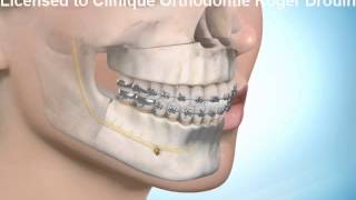 Avancement du maxillaire avec recule de la mandibule