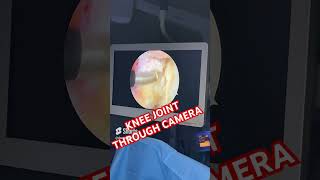 Knee joint through camera