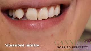 Ponte in zirconio ceramica