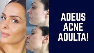 O ASSUNTO É ACNE ADULTA!  - DICAS DE BELEZA Por Vanessa Machadoa