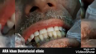 Full Denture insertion