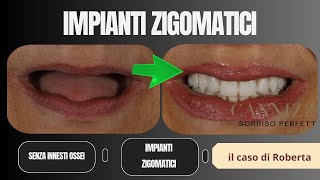 Caso impianto zigomatico applicato in assenza di osso - Studio Cannizzo Milano