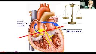 11 - Preexitación ventricular (patrón Wolff-Parkinson-White)