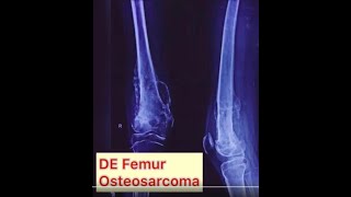 Knee joint replacement surgery:  Distal Femur Bone tumor Surgery with Megaprosthesis