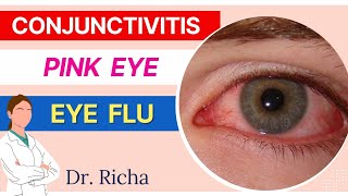 Conjunctivitis ll Eye Flu ll आँखों में इन्फेक्शन || Hindi || Symptoms, Signs & Precautions.