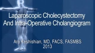 Laparoscopic Cholecystectomy and Intra-Operative Cholangiogram