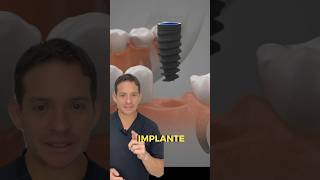 IMPLANTE DENTAL