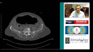 CT of Cecal Volvulus and Complications by Dr Arjun Kalyanpur