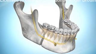 Avancement de la mandibule par chirurgie