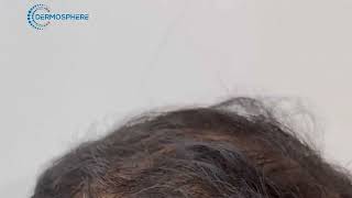 Hair transplant results @dermosphereclinic