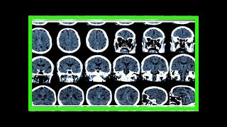 L'anomalie à l'origine de la maladie de Parkinson découverte par une équipe de chercheurs franco-be