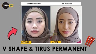 CARA NGILANGIN LEMAK PIPI PERMANENT - MUKA TIRUS DAN V SHAPE SELAMANYA, OPERASI BUCCAL FAT PAD