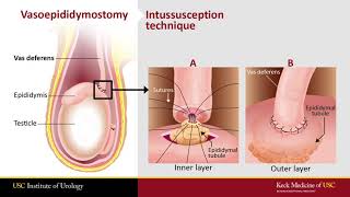 Vasectomy Reversals: What Every Patient Should Know