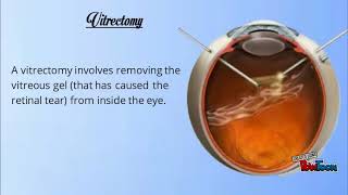 Retinal Detachment  - Mr Mahi Muqit PhD FRCOphth