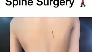 Animasi Spine surgery