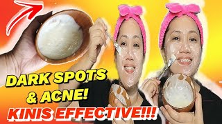 DARK SPOTS at ACNE REMEDY NA EFFECTIVE BINABALIK BALIKAN KO