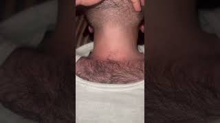 Ingrown #hair #hairsalon #hairandbeard #hairstyle #barbersurgion #beard #relax #hairremoval #beard