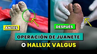 Operación y recuperación de JUANTE O HALLUX VALGUS.- dr.julio quiroz