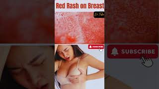 स्तन पर लाल चकत्ते: कारण, लक्षण और राहत | rashes on the breast #breast #woman #issue #pain #shorts