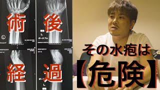 【手術 後 水疱 水ぶくれ 1カ月治療経過観察】その水ぶくれ つぶすの？潰さない？どっちが正解！？治療終了までの観察！