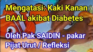 Mengatasi: Kaki Kanan BAAL akibat Diabetes || Oleh Pak SAIDIN - pakar Pijat Urut / Refleksi