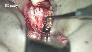 Apicoectomy