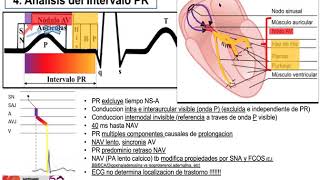 7 -  Bloqueo auriculo-ventricular (BAV)