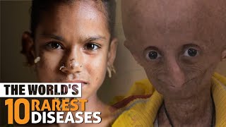 The World's 10 Rarest Diseases | Info Junkie TV