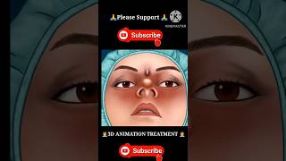 3D Animation Treatment Video #shorts #tranding #ytshorts #reels