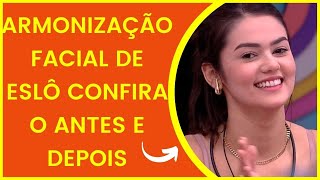 Ex BBB22 Eslovênia faz harmonização facial! Veja o antes e depois