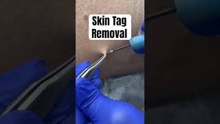 Skin tag removal #skintags #skintagremoval #clearskin