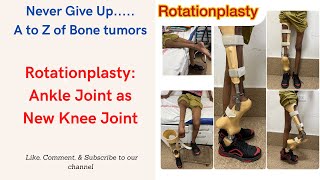 Rotationplasty Reversed Ankle Joint working as New Knee Joint