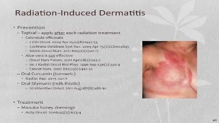 Calendula for Radiation induced Dermatitis