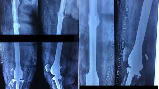 Tumor Prosthesis or Megaprosthesis Joint Replacement  in Trauma or Non Oncology or  Non Cancer