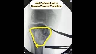 Benign Bone Tumors:Well defined border & Narrow zone of transition