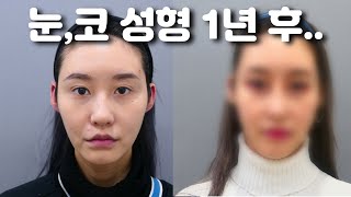 역대급으로 자연스러운 눈,코 성형...!