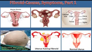 Fibroid Causes, Symptoms, Part 1