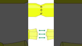 end to end anastomosis Facial Nerve