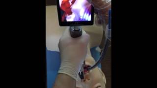 video laryngeal scope