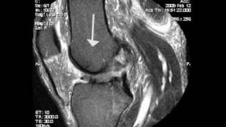 Anterior Cruciate Ligament Injury Overview