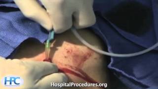 subclavian line video