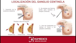 Localización del Ganglio Centinela