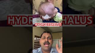 Hydrocephalus